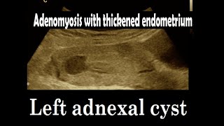 Adenomyosis  Thickened endometrium  Adnexal cyst  Amader hospital  Ultrasonography report [upl. by Audry]