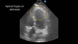 Chest Pain and Automated ECG Read of Nonspecific STwave Abnormalities [upl. by Emelen]