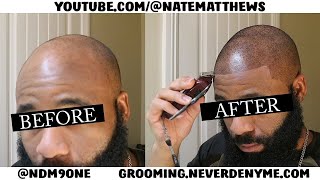 How To Get Your Hairline Back  From Bald To Edge Up  Hairline Restoration [upl. by Assiralc]