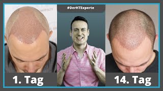 Die ersten 1  14 Tage nach Haartransplantation Heilungsverlauf [upl. by Atinej527]