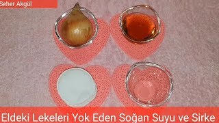 Güneş Lekeleri ve Yaşlılık Lekelerine Soğan Suyuyla Kesin Çözüm [upl. by Lahcsap]