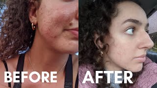 DID DOXYCYCLINE WORK  My Doxycycline Experience Doxycycline for Acne Before and After Pictures [upl. by Norbie]