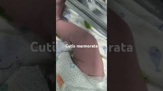 Cutis marmoratanewborn paeds clinical [upl. by Grekin58]