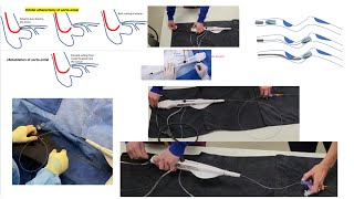 Rotational atherectomy advanced techniques with videos  Orbital atherectomy tips Elias Hanna [upl. by Darnell]