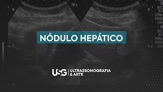 Nódulo hepático [upl. by Aisatsana]