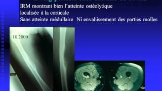 Diagnostic et classifications actuelles des sarcomes osseux du genou [upl. by Danczyk63]