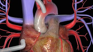 KoronararterienBypass CABG [upl. by Madel819]