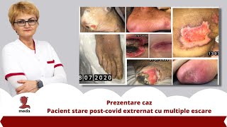 Prezentare caz  Pacient stare postcovid extrernat cu multiple escare  Promo medatalos nursery [upl. by Anahoj]