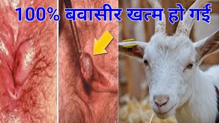 100 साल पुरानी बवासीर 2 मिनट में ठीक हो गई  Permanent Cure of Piles [upl. by Razatlab]