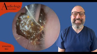 Surprising Earwax Removal Twist and Peel  EP864 [upl. by Nonahs435]