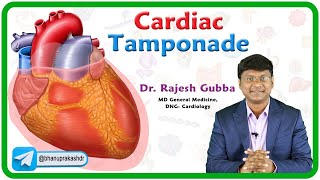 Cardiac Tamponade  Etiology Pathophysiology Clinical features Diagnosis and Treatment [upl. by Atirrehs]