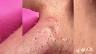 Asmr blackhead removal treatment Satisfaction video [upl. by Chilcote]