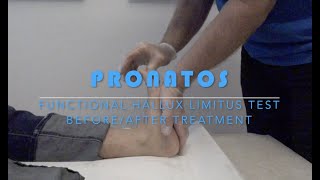 FUNCTIONAL HALLUX LIMITUS TEST BEFORE AND AFTER TREATMENT [upl. by Friedly]