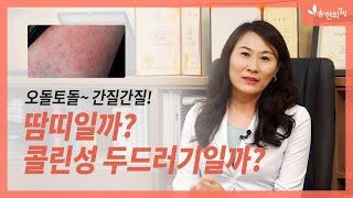 여름철 가려움 땀띠 콜린성 두르러기 콜린성두드러기의 다양한 형태 [upl. by Acissey]