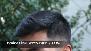 FUE Hair transplant Hairtransplant turkey Hairline lowering [upl. by Aelsel526]