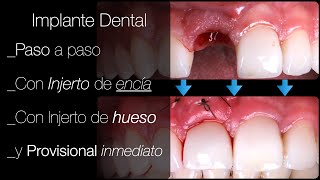 📌𝗜𝗡𝗙𝗢𝗥𝗠𝗔𝗖𝗜𝗢𝗡 𝗖𝗟𝗔𝗩𝗘 sobre la 𝗖𝗢𝗟𝗢𝗖𝗔𝗖𝗜𝗢𝗡 𝗜𝗠𝗣𝗟𝗔𝗡𝗧𝗘𝗦 dentales paso a paso explicada TE INTERESA 👌 [upl. by Rowland126]