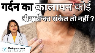 ACANTHOSIS NIGRICANS गर्दन का कालापन कोई बीमारी का संकेत तो नहीं [upl. by Attiuqihc523]