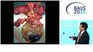 BAUS15 Epidemiology amp Risk Stratification of Urosepsis [upl. by Anirrok]