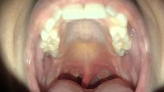 Tonsillectomy healing day 11 [upl. by Raul]