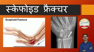 Scaphoid Fracture  All you want to know Hindi स्केफोइड फ्रैक्चर [upl. by Damaris]