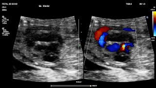 Clues to fetal echo Ebstein anomaly with VSD Dr Parag Bhalgat [upl. by Yornoc]