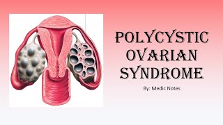 OampG Polycystic ovarian syndrome  samps investigation treatment [upl. by Ahsait]