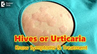 Doctor explains how to RECOGNISE AND TREAT JOCK ITCH aka Tinea Cruris or Ringworm of the groin [upl. by Alano]