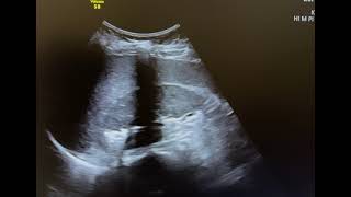 Ultrasound of emphysematous pyelonephritis [upl. by Anika]