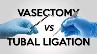 Vasectomy vs Tubal Ligation [upl. by Uon]