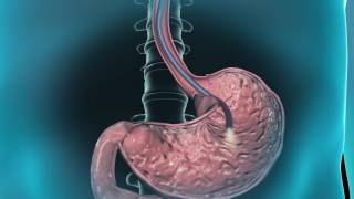 Learn about gastroscopy [upl. by Lerrad]