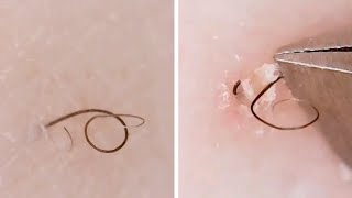 Compilation Of Ingrown Hairs In Girls Leg [upl. by Aennaej]