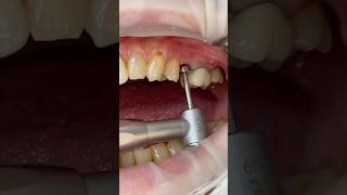 임플란트 세멘리스보철 dental dentist implantdentist cementless [upl. by Nyrrek]