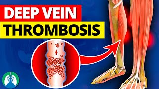 Deep Vein Thrombosis DVT  Quick Medical Overview [upl. by Gnes]