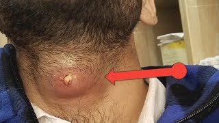 large Neck Abscess Removal [upl. by Lemmor332]