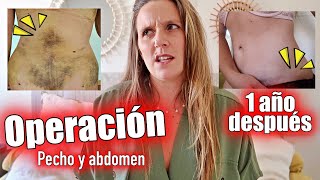 CAMBIO RADICAL tras mi OPERACIÓN de pecho y abdomen😱QampA Happy Ohana [upl. by Ardnusal]