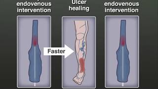 Treating Venous Leg Ulcers [upl. by Veljkov521]