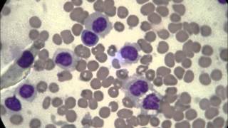 Hairy Cell Leukemia [upl. by Fin]