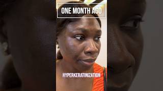 Meet Ms Adeola 🤩✨ who tackled HyperMelanosis with our Hyperpigmentation Treatment Protocol HTP✨ [upl. by Stetson821]