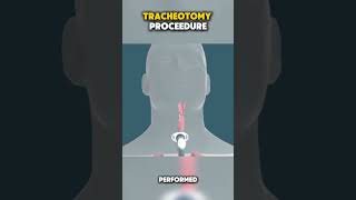 Tracheotomy doctor airway throatcancer throatinfection breathing explore medicovlogs [upl. by Liesa]