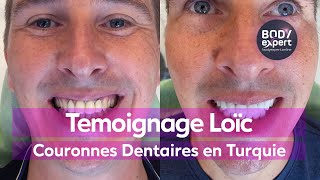 SOINS DENTAIRES  🦷 Témoignage Loïc  24 couronnes dentaires Emax  BODYEXPERT [upl. by Betta14]