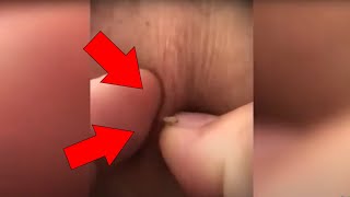 Ultimate Pimple Popping 2024 Top Pimple Extractions [upl. by Hoban]