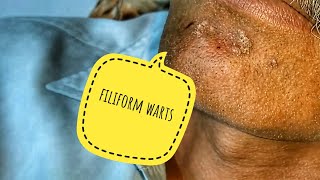 Warts on face  filiform warts removed [upl. by Stover]