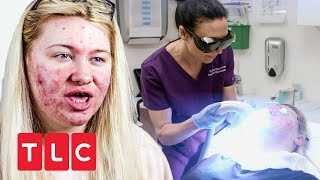 Laser gegen Akne  Dr Emma Hautärztin aus Leidenschaft  TLC Deutschland [upl. by Attenat595]