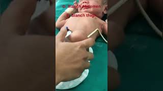 How to check for jaundiceicterus in a newborn [upl. by Dalury586]