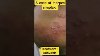 a case of Herpes simplex medical treatment diagnosis disease shorts health casestudy viral [upl. by Notyal]