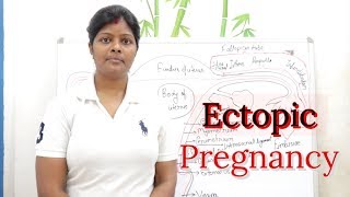 ectopic pregnancy lecture in hindi  definition  types  etiology or causes  signs and symptoms [upl. by Paterson]