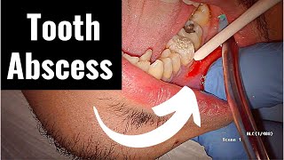 Incision and Drainage of Tooth Abscess Draining Pus [upl. by Malvino174]