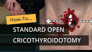 Standard Open Cricothyroidotomy [upl. by Aenit]