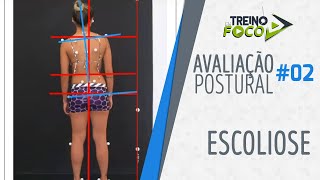 Desvio Postural de Coluna  Escoliose  Avaliação Postural 02 [upl. by Finbar]