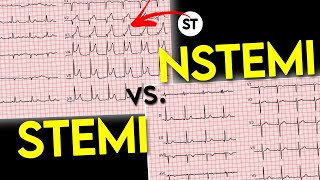 ECG interpretation  STEMI vs NSTEMI  ECG of Myocardial Infraction • Daily Cardiology [upl. by Manaker]